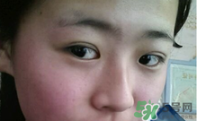 埋線雙眼皮需要拆線嗎？埋線雙眼皮怎么拆線