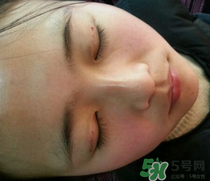 埋線雙眼皮需要拆線嗎？埋線雙眼皮怎么拆線