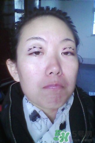 什么是定點雙眼皮？定點雙眼皮多少錢？