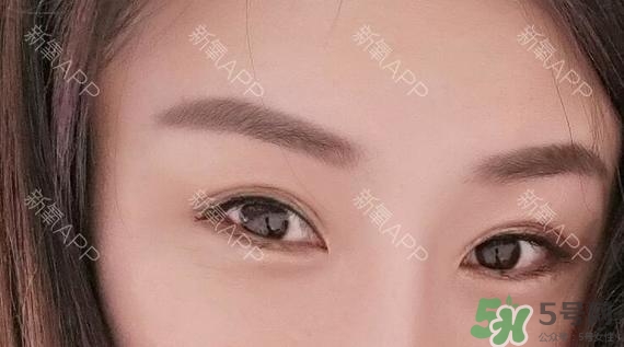 埋線雙眼皮能保持多久？埋線雙眼皮是永久嗎