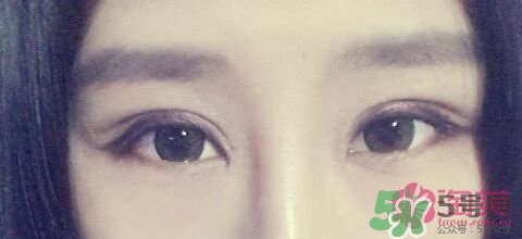 切開雙眼皮多久消腫？切開雙眼皮多久恢復(fù)？