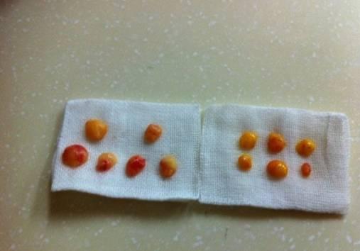 韓式三點雙眼皮是永久嗎？三點雙眼皮能保持多久？
