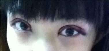 韓式三點雙眼皮是永久嗎？三點雙眼皮能保持多久？