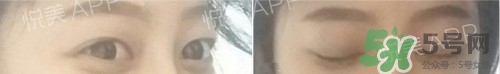 埋線雙眼皮多久恢復自然？埋線雙眼皮多久能恢復