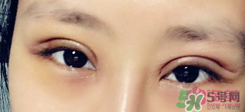 切開雙眼皮多久消腫？切開雙眼皮多久恢復(fù)？