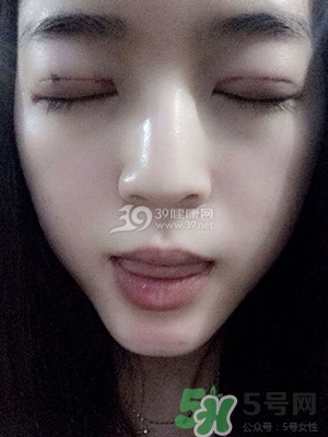 什么是定點雙眼皮？定點雙眼皮多少錢？