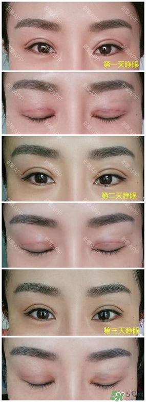 埋線雙眼皮能保持多久？埋線雙眼皮是永久嗎