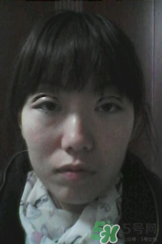 什么是定點雙眼皮？定點雙眼皮多少錢？