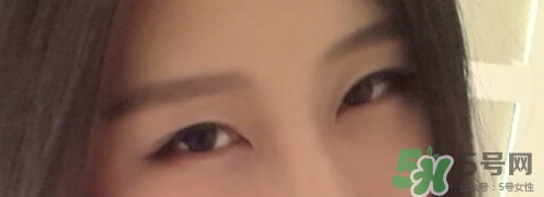 切開雙眼皮多久消腫？切開雙眼皮多久恢復(fù)？