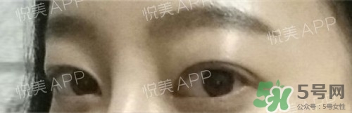 埋線雙眼皮多久恢復自然？埋線雙眼皮多久能恢復