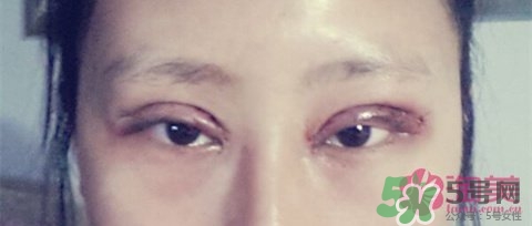 切開雙眼皮多久消腫？切開雙眼皮多久恢復(fù)？