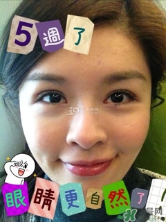 重瞼術(shù)是什么？重瞼術(shù)是永久的嗎？