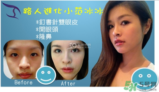 重瞼術(shù)是什么？重瞼術(shù)是永久的嗎？