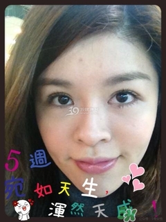 重瞼術(shù)是什么？重瞼術(shù)是永久的嗎？