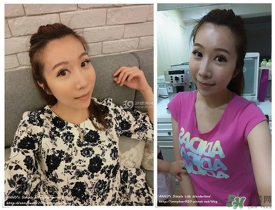 重瞼術(shù)多久能完全消腫 重瞼術(shù)恢復過程圖