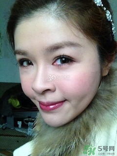 重瞼術(shù)是什么？重瞼術(shù)是永久的嗎？
