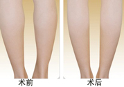 小腿吸脂多久見(jiàn)效？小腿吸脂后多久能看見(jiàn)效果？