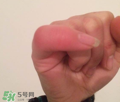 小拇指凍腫了怎么辦？為什么小拇指容易凍？
