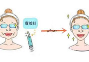咬肌會(huì)改變臉型嗎？切除咬肌會(huì)改變臉型嗎？