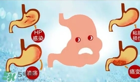 神經(jīng)性胃痙攣是什么？神經(jīng)性胃痙攣是什么原因？