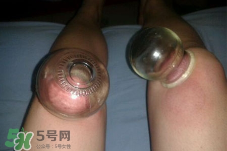 小腿能拔罐嗎？在小腿上拔火罐有什么作用？
