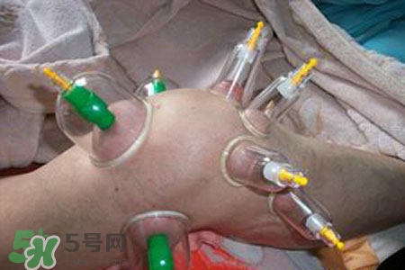 小腿能拔罐嗎？在小腿上拔火罐有什么作用？
