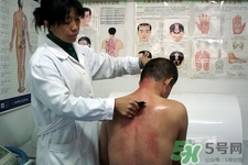 刮痧可以減肥嗎？刮痧減肥有效果嗎？