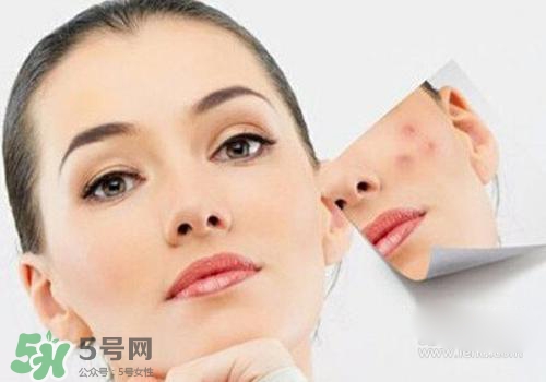封閉性粉刺會自己消失嗎？封閉性粉刺好了會留疤嗎？