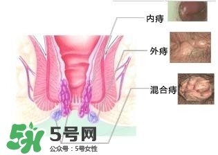 痔瘡吃什么藥效果好？痔瘡吃什么藥好得快？