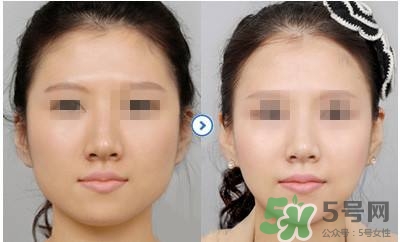打瘦臉針疼不疼？打瘦臉針的注意事項(xiàng)