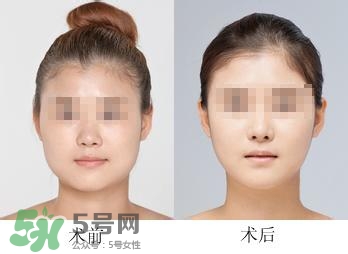 打瘦臉針能喝酒嗎？打瘦臉針能吃海鮮嗎？