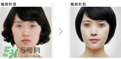 打瘦臉針能喝酒嗎？打瘦臉針能吃海鮮嗎？