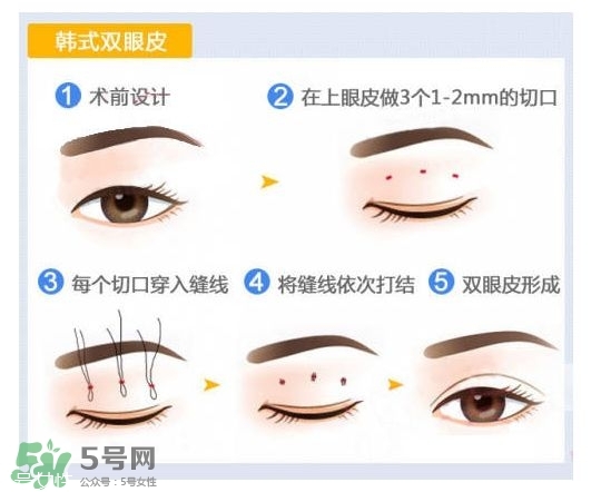 割雙眼皮有幾種做法？雙眼皮有哪幾種形狀？