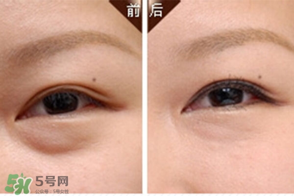 臥蠶是黑眼圈嗎？臥蠶和黑眼圈的區(qū)別