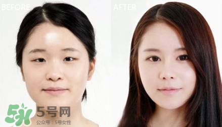 割雙眼皮有什么后遺癥嗎？割雙眼皮有什么危害性？