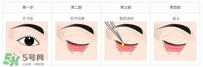 眼袋是怎么形成的？手術(shù)去眼袋安全嗎