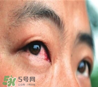 紅眼病是怎么引起的？紅眼病怎么產(chǎn)生的