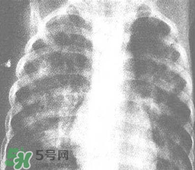 紅眼病是怎么引起的？紅眼病怎么產(chǎn)生的