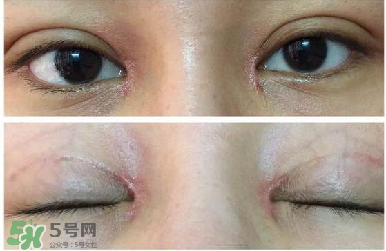 眼角增生是什么意思？眼角增生了怎么辦？