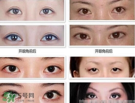 哪些人需要開(kāi)眼角？需要開(kāi)眼角的眼睛圖片