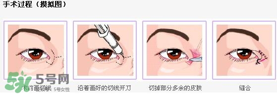 哪些人需要開(kāi)眼角？需要開(kāi)眼角的眼睛圖片