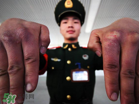 三月份還長(zhǎng)凍瘡嗎？三月份凍瘡沒好怎么辦？