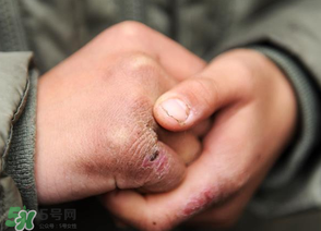 三月份還長(zhǎng)凍瘡嗎？三月份凍瘡沒好怎么辦？