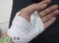 傷口化膿怎么處理？傷口化膿用什么藥好？