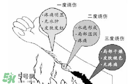 燙傷起泡要挑破嗎？燙傷起泡怎么處理？