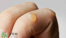 燙傷起泡要挑破嗎？燙傷起泡怎么處理？