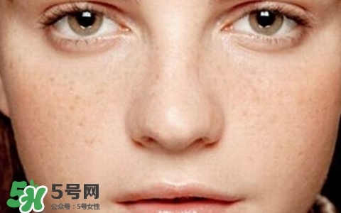 長(zhǎng)斑是什么原因引起的？祛斑效果最好的方法