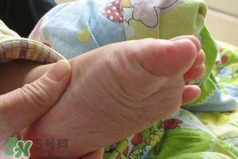 手足口病如何預防？手足口病怎樣預防