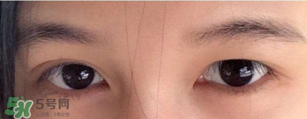 眼睛發(fā)黃是怎么回事？眼睛發(fā)黃是什么原因