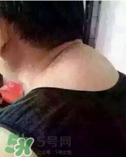 刮痧之后可以艾灸嗎？刮痧之后可不可以艾灸